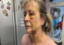 Kay Crisp was left with multiple fractures in her face following the attack