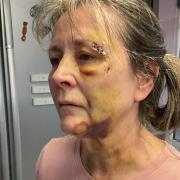 Kay Crisp was left with multiple fractures in her face following the attack